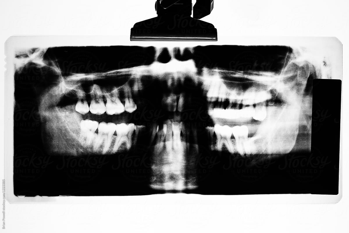 panoramic x-ray of teeth