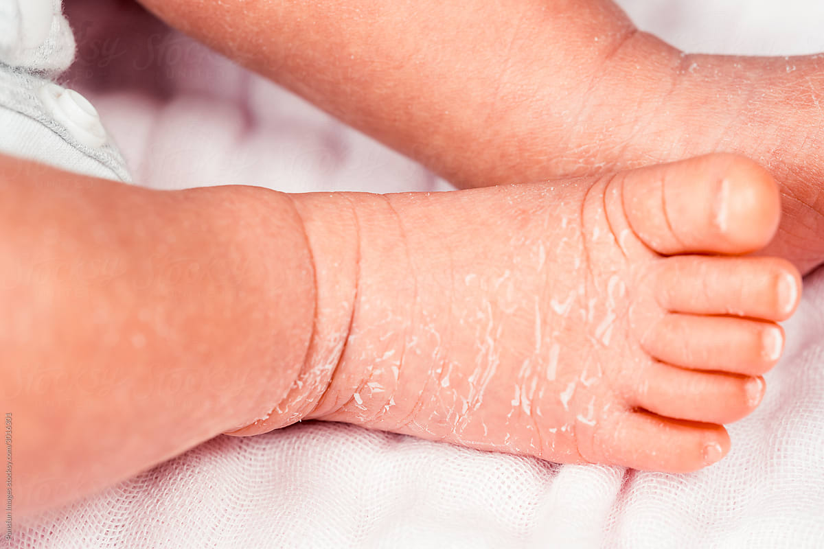 Dry skin on newborn baby feet