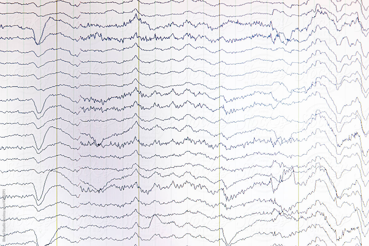 Electroencephalogram showing rhythm of brain activity