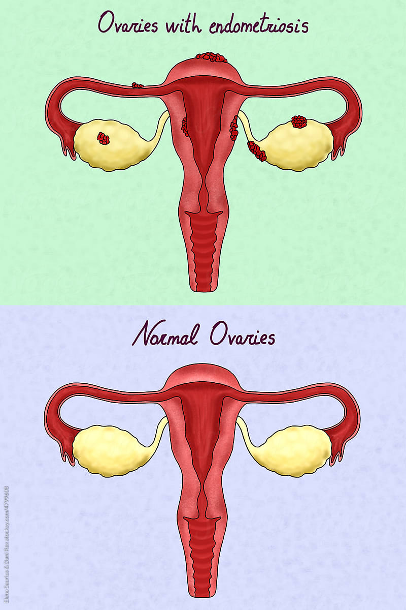 Two female reproductive system illustration, one with endometriosis