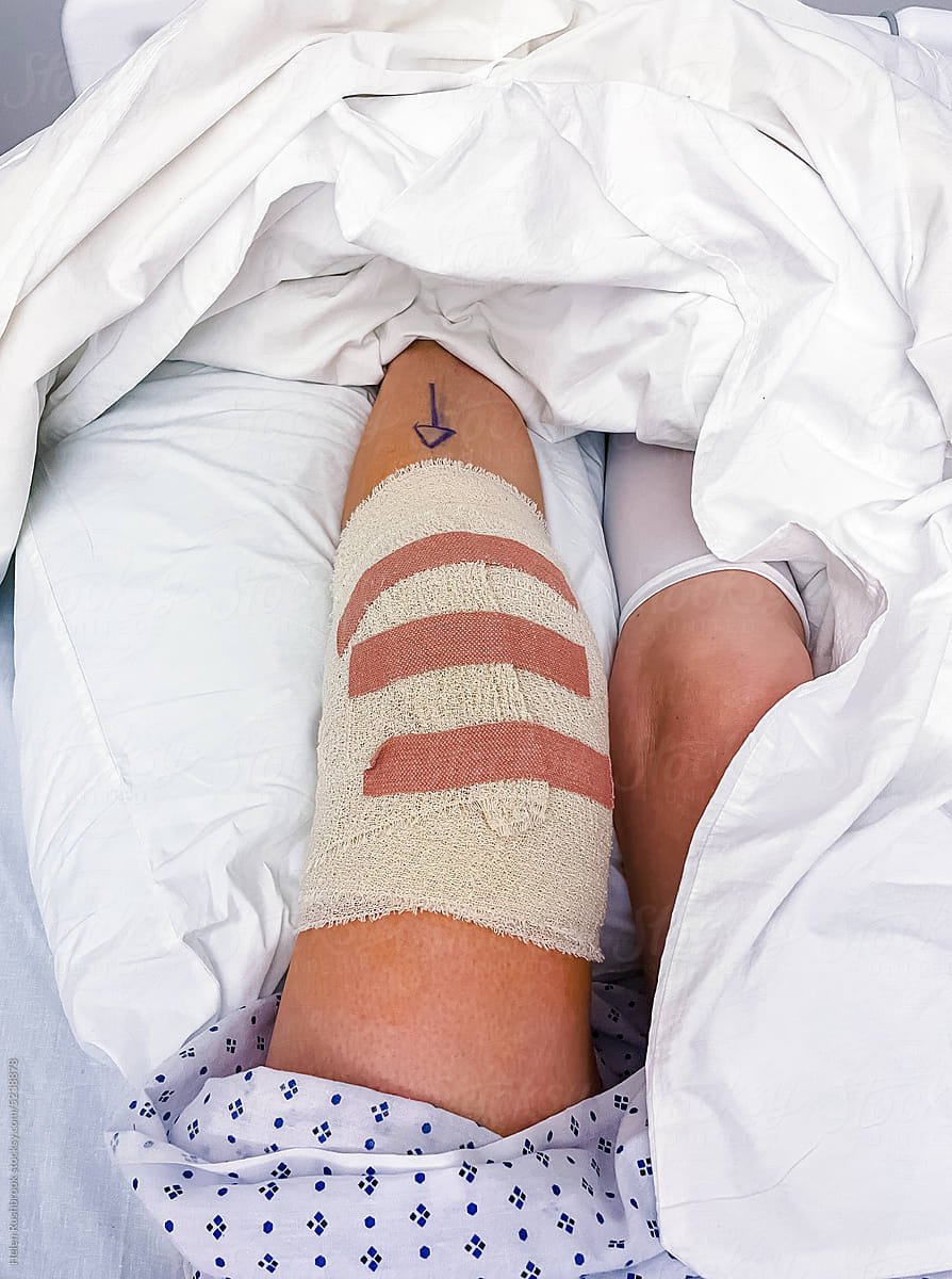 UGC image of a bandaged knee post-surgery.