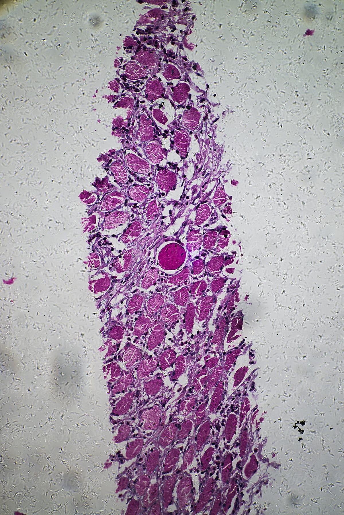 Eosinophilic granuloma of human