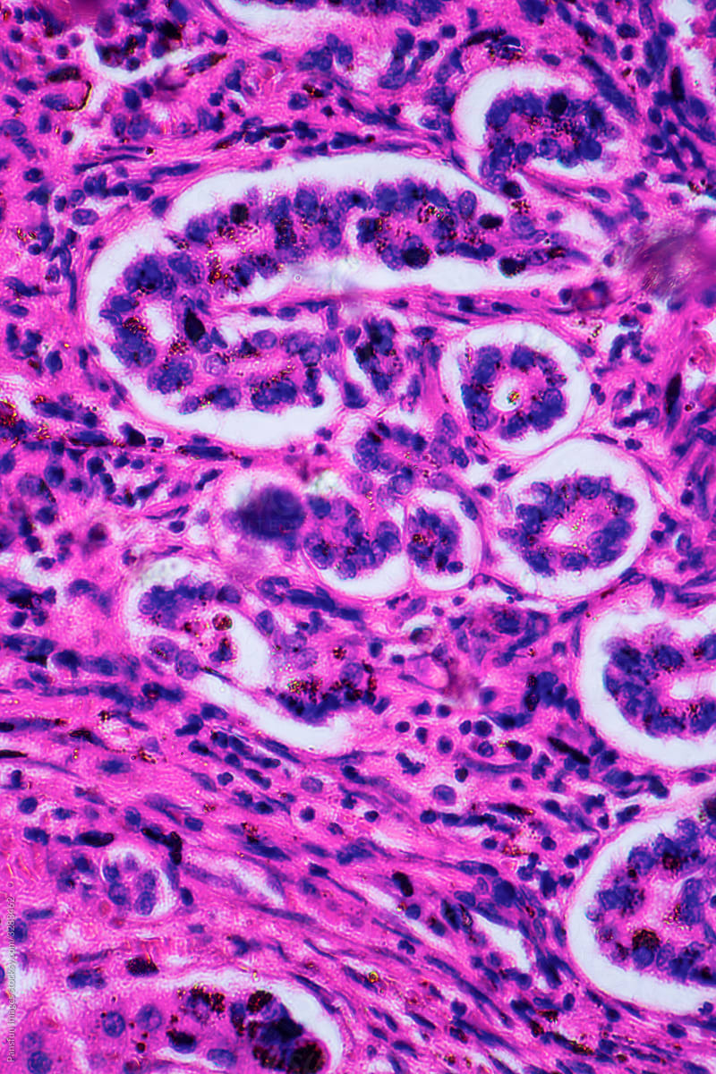 ill human liver cells of biliary cirrhosis