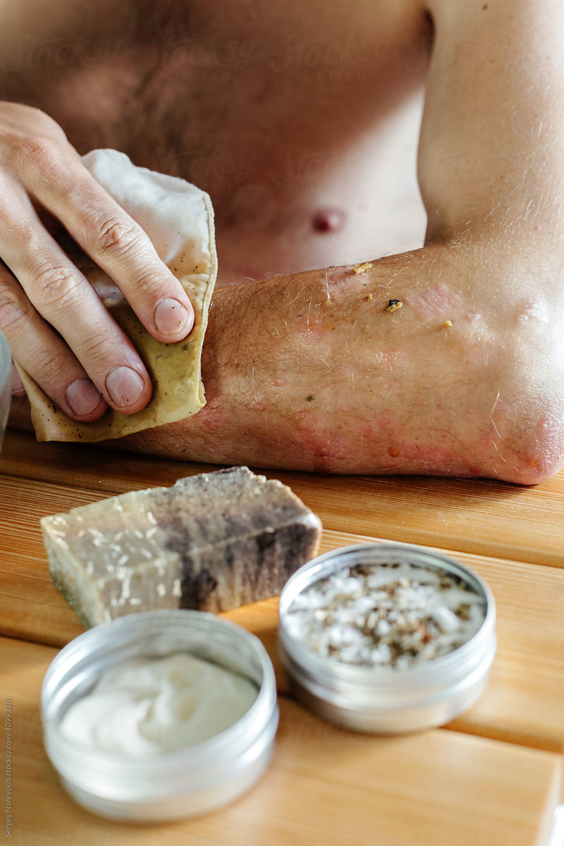 Man with psoriasis applying herbal decoction with cloth