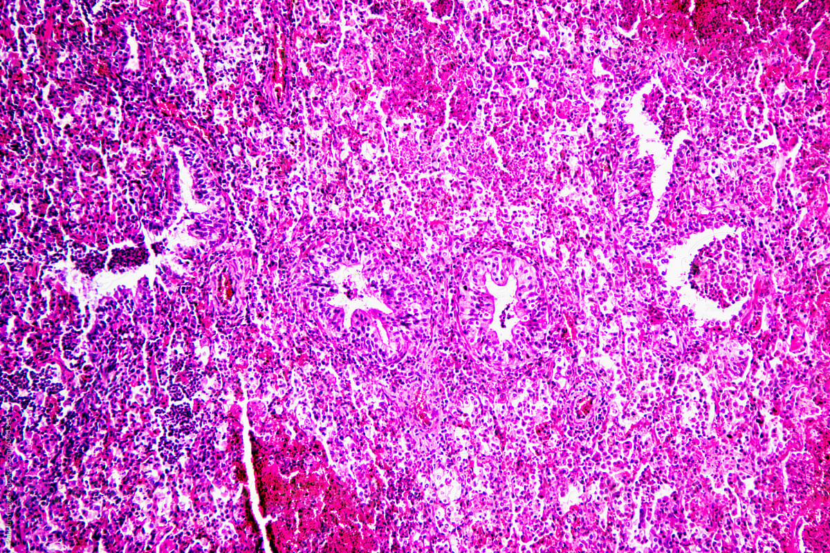 Micrograph of lobar pneumonia red hepatization stage