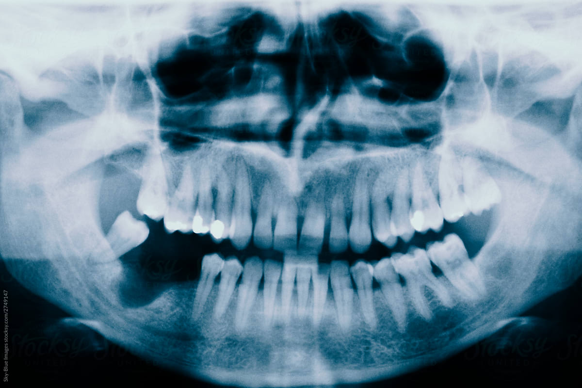 X-ray of human mouth and teeth