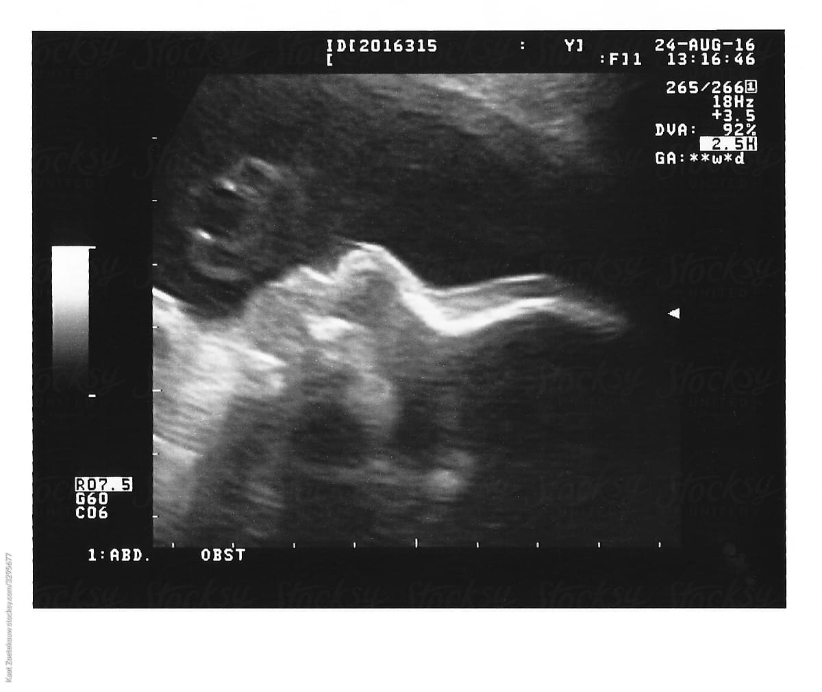 Sonogram of baby at 29 weeks