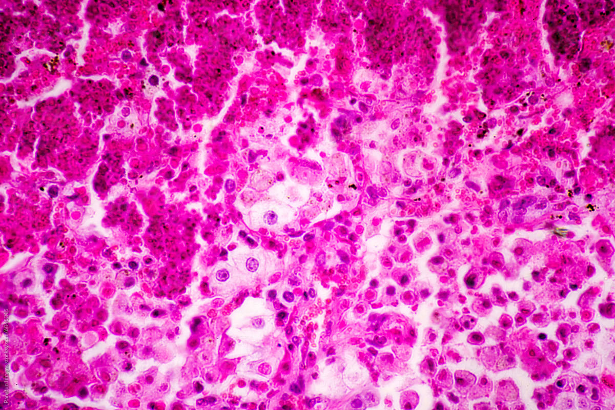 Micrograph of lobar pneumonia red hepatization stage