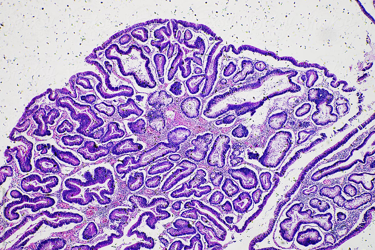 Intestinal adenomatosis