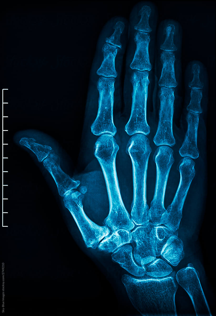 X-ray of an human hand