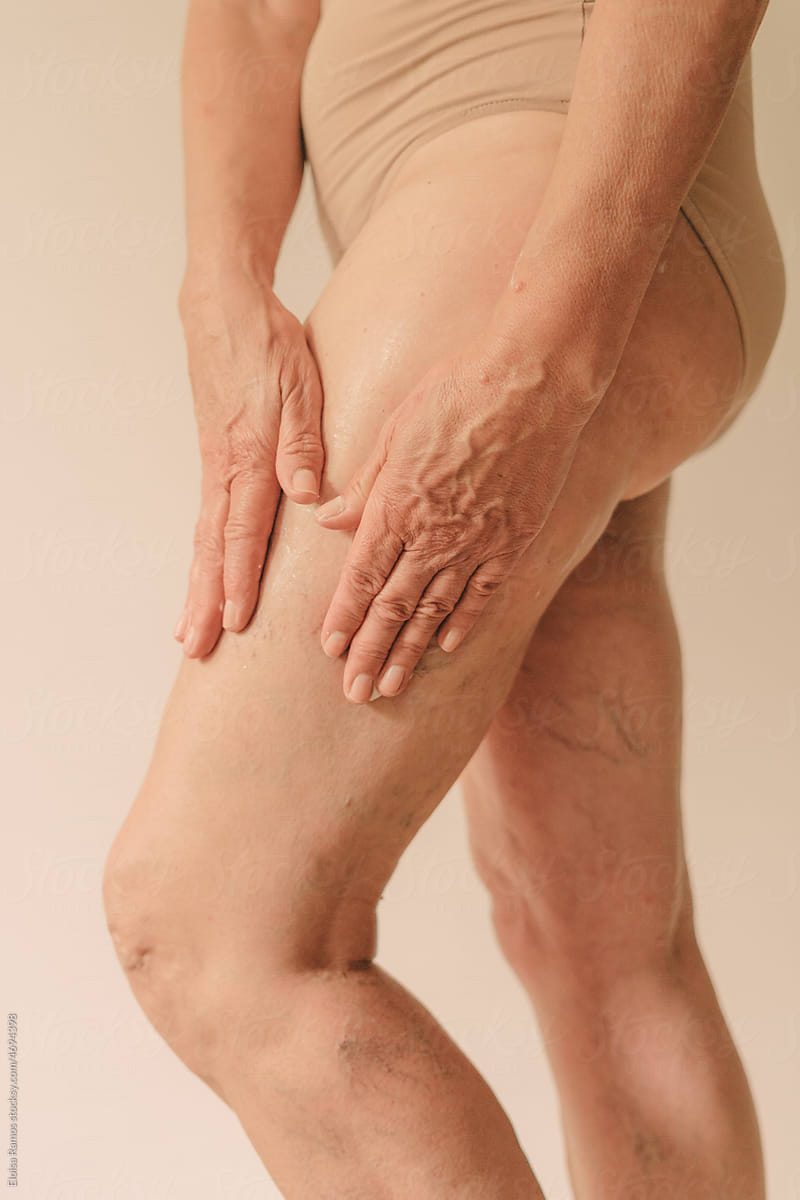 Legs Of Senior Woman With Varicose Veins» del colaborador de