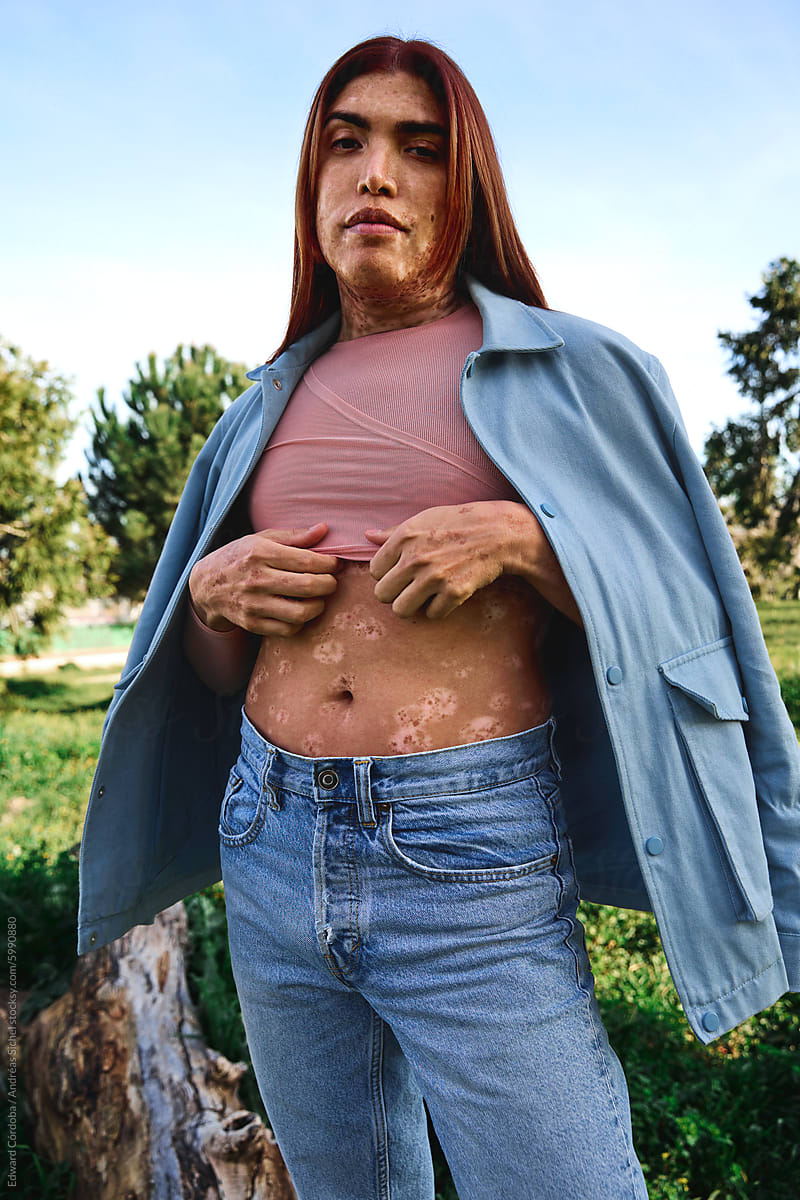 Portrait of a young non-binary person with beautiful vitiligo skin