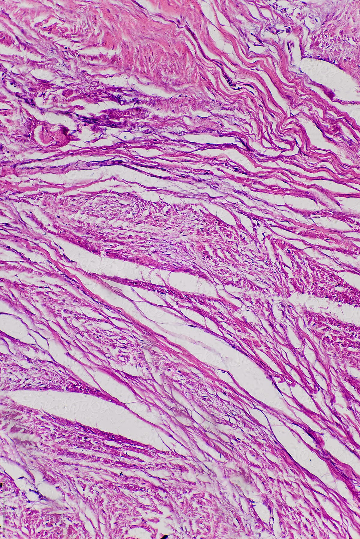 Connective tissue hyaline degeneration of human