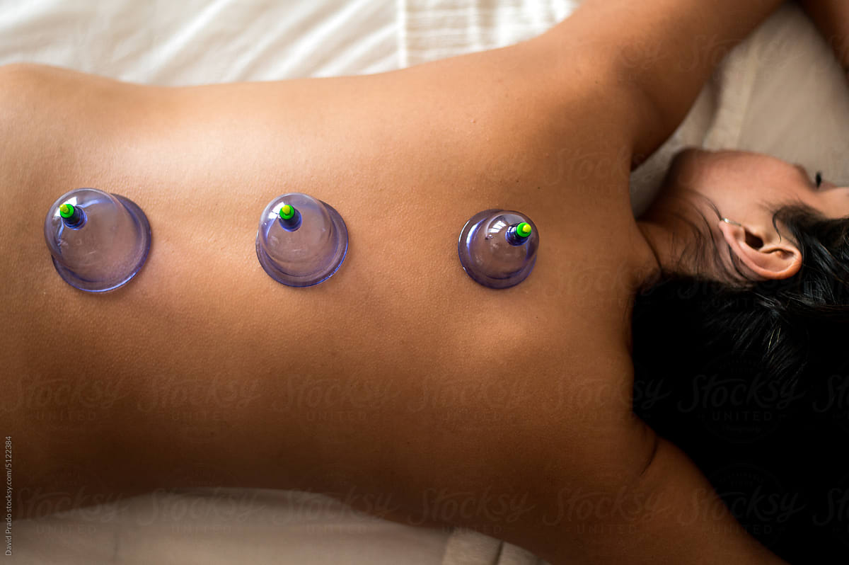 Client getting cupping therapy