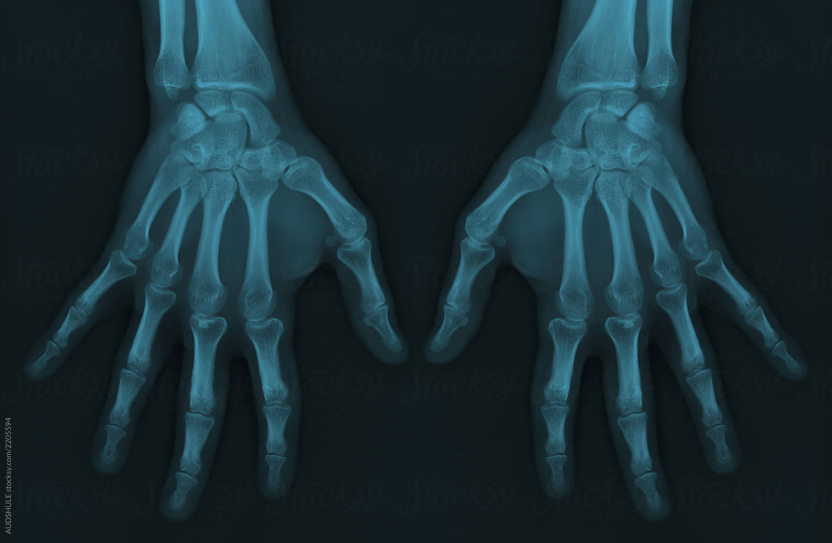 X-Ray Of The Hands