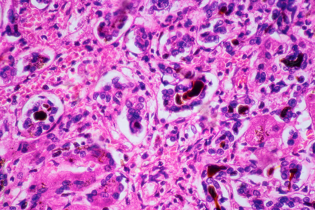 ill human liver cells of biliary cirrhosis