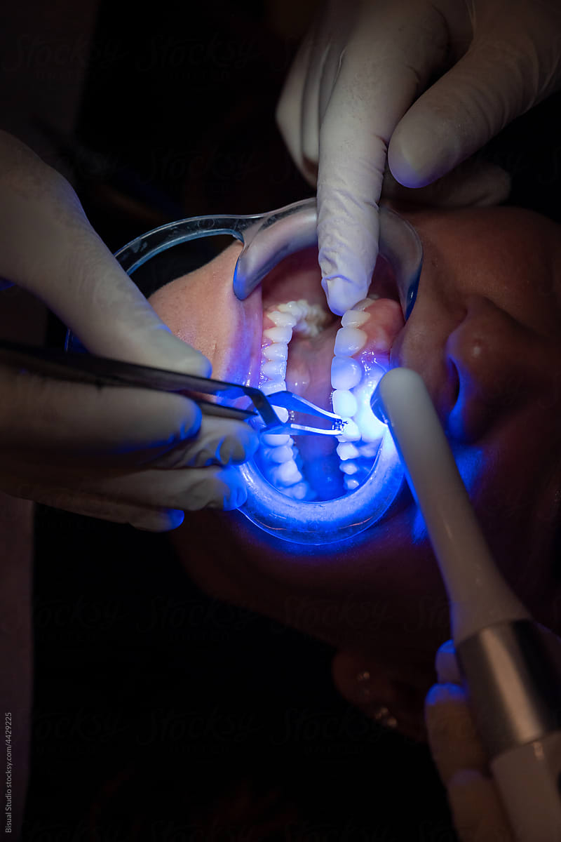 Crop dentists putting tooth filling to patient