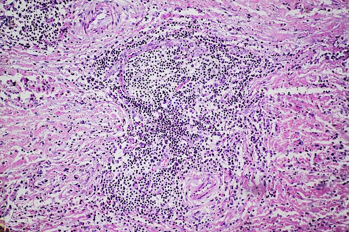 Eosinophilic Granuloma Of Human By Stocksy Contributor Pansfun