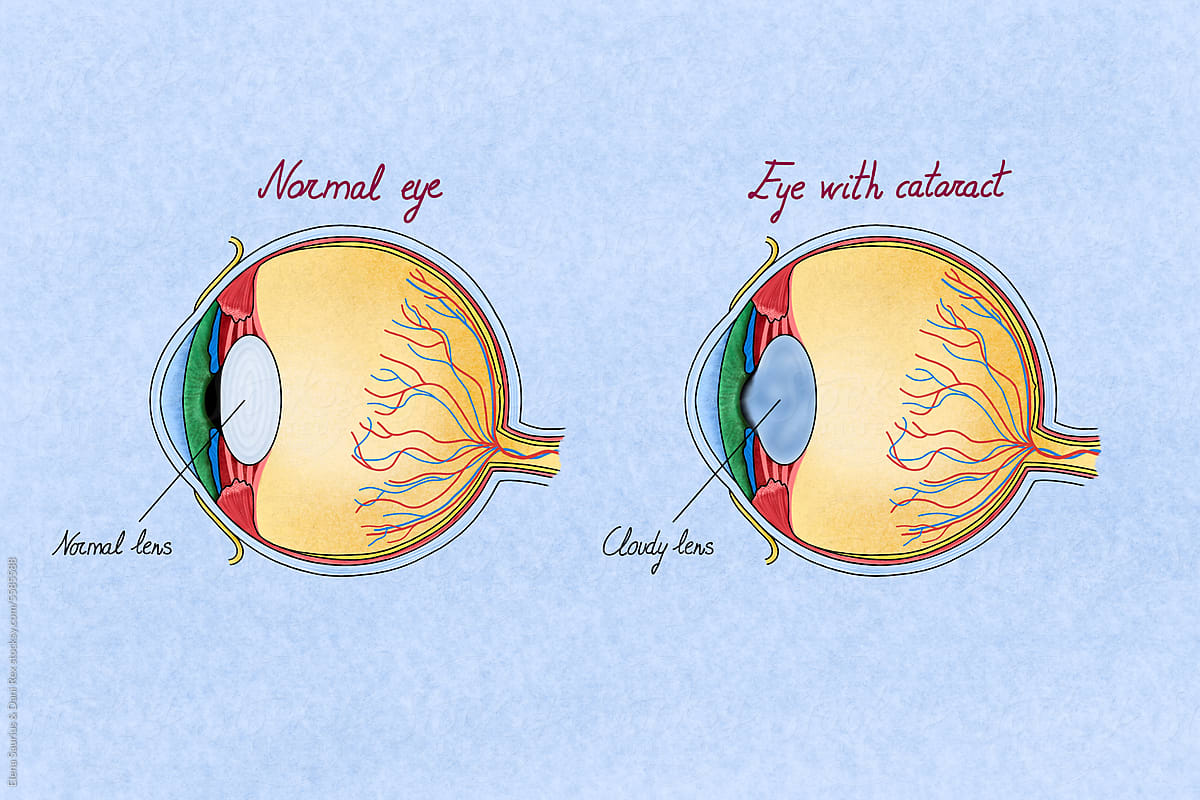 Human normal eye vs a eye with cataracts. Illustration