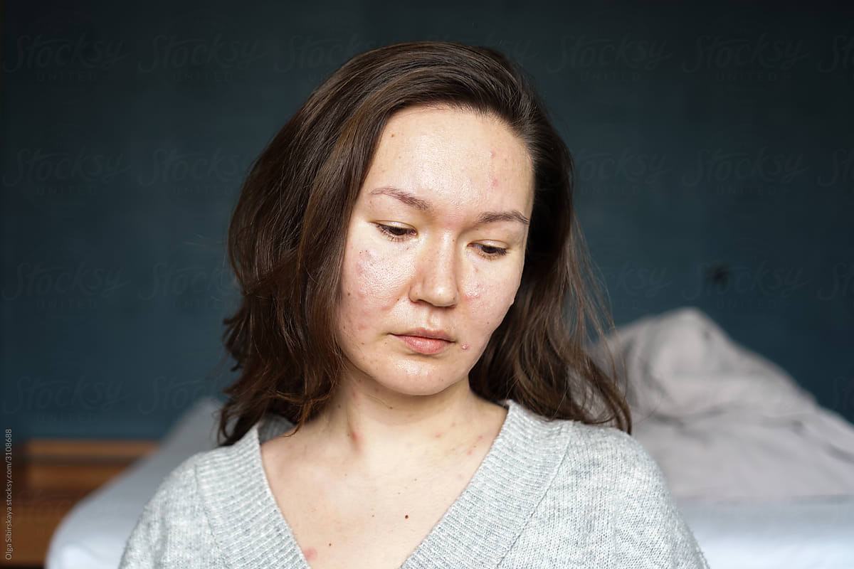 woman portrait pimples
