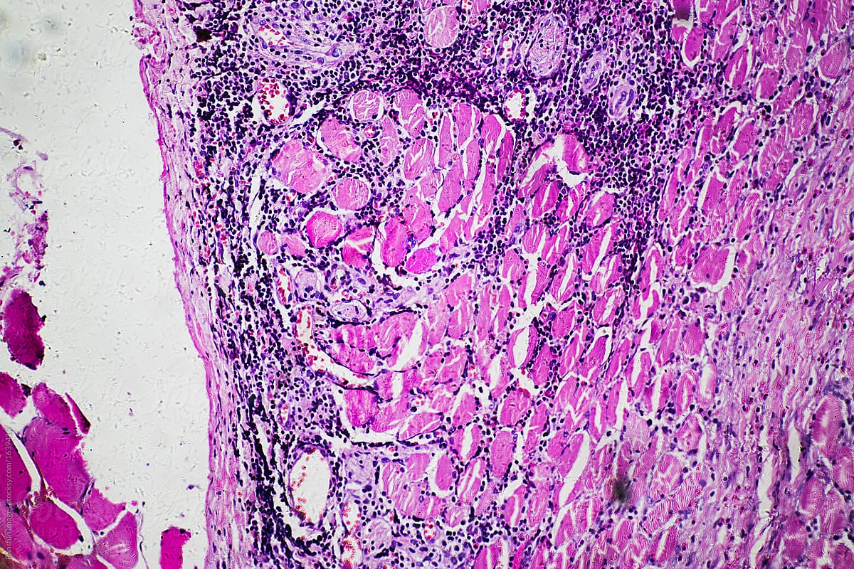 Eosinophilic granuloma of human