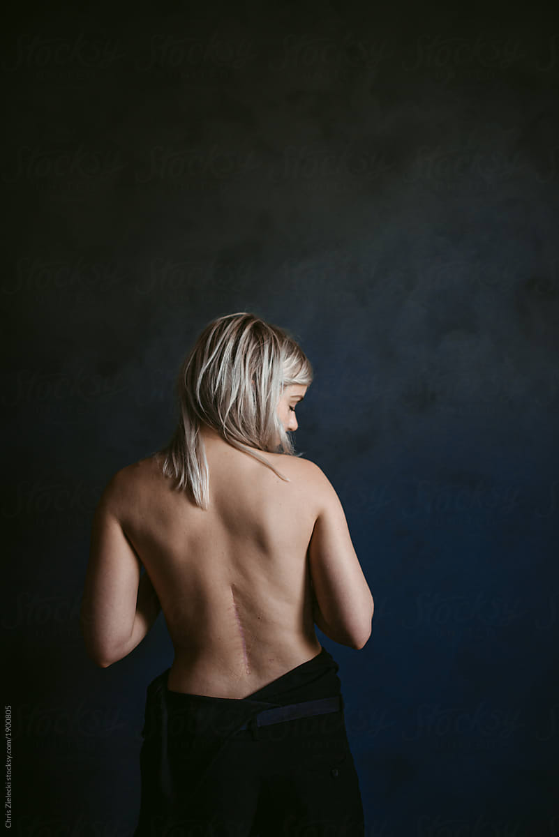 Young naked anonymous woman with scar on back at home