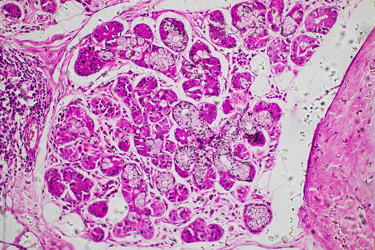 Squamous metaplasia of bronchial mucosa by Pansfun Images - Medical