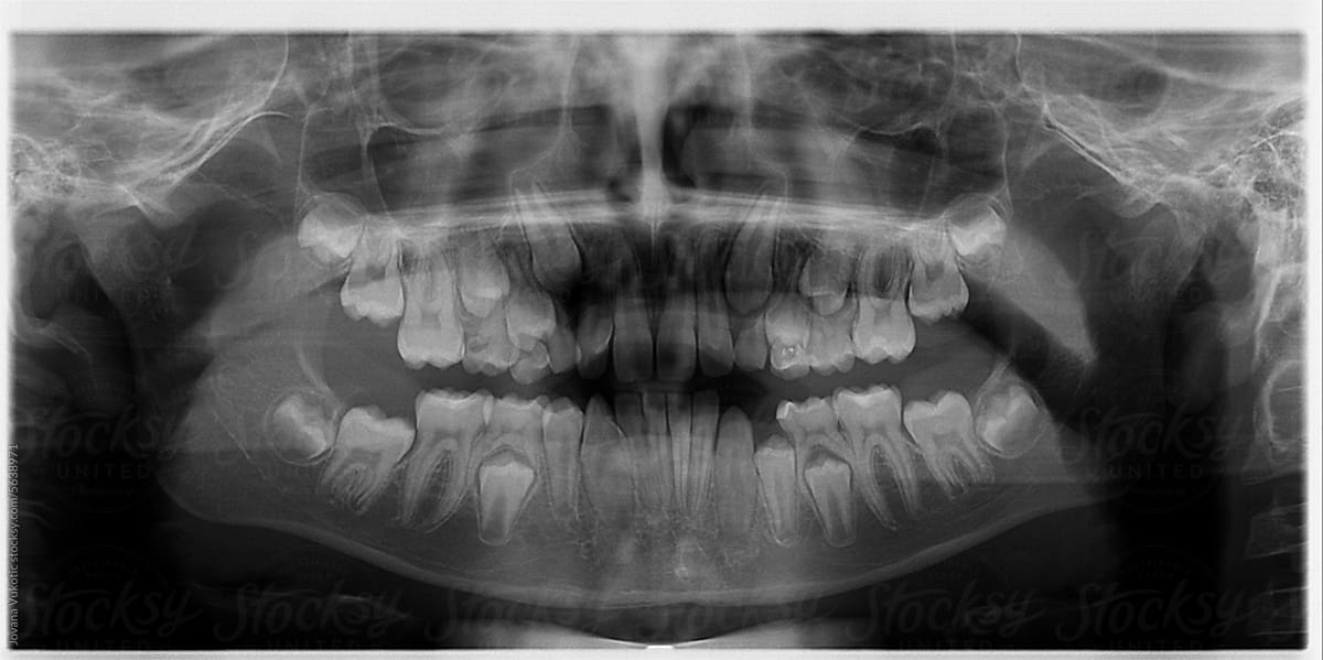 X ray dentist scan