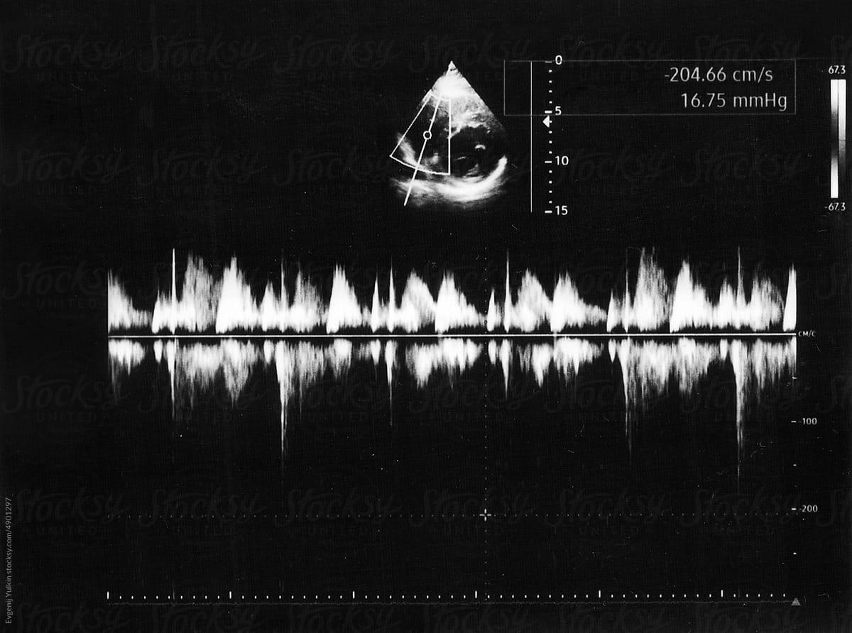 Echocardiography image
