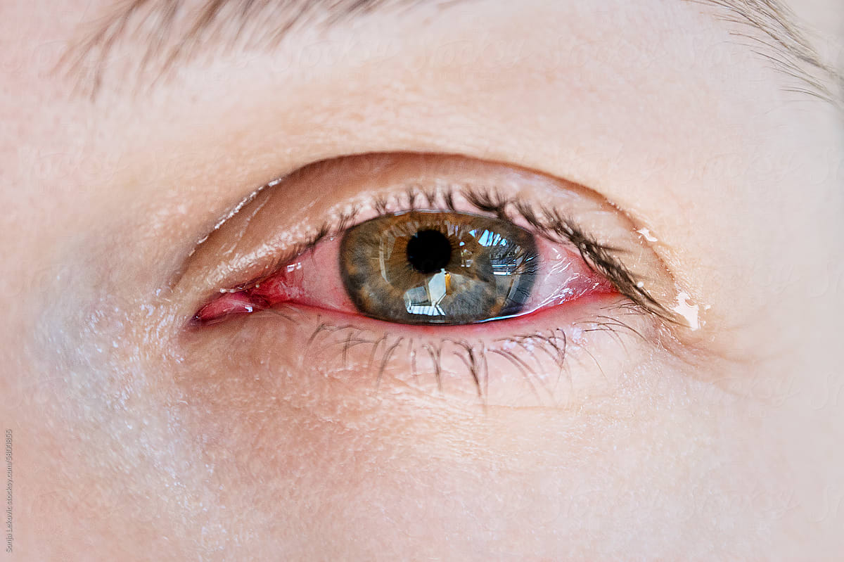 Eye infection, blood and tear closeup