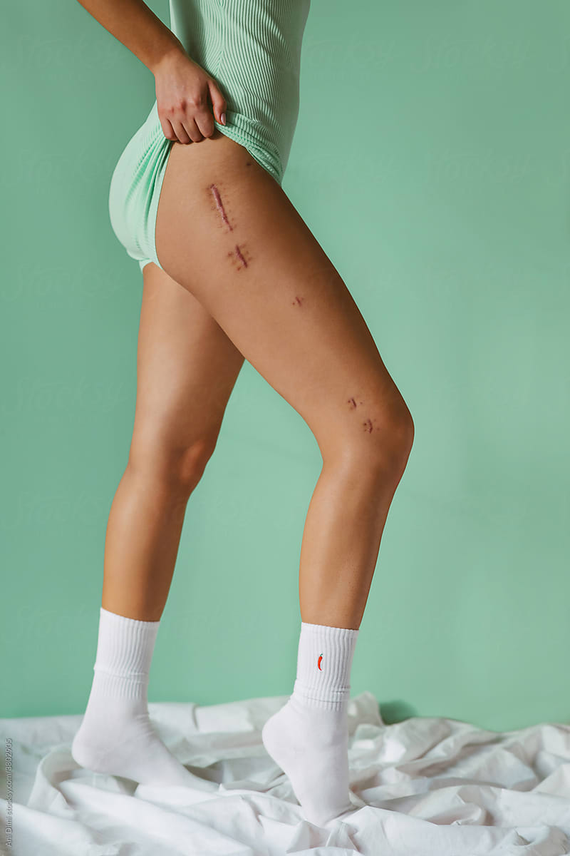 Closeup Of Young Woman Legs With Surgery Scar On Her Leg