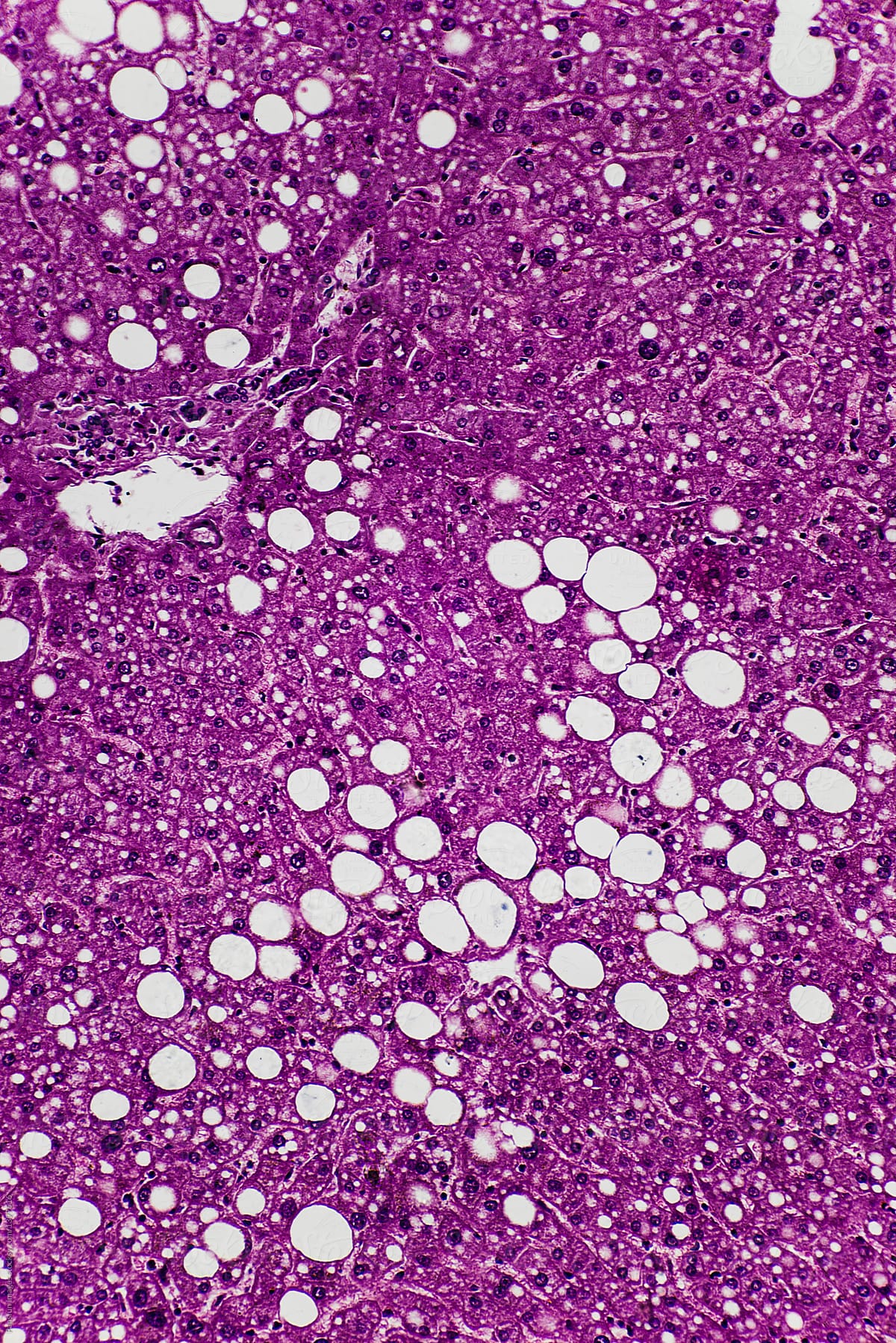 human liver tissue showing fatty degeneration
