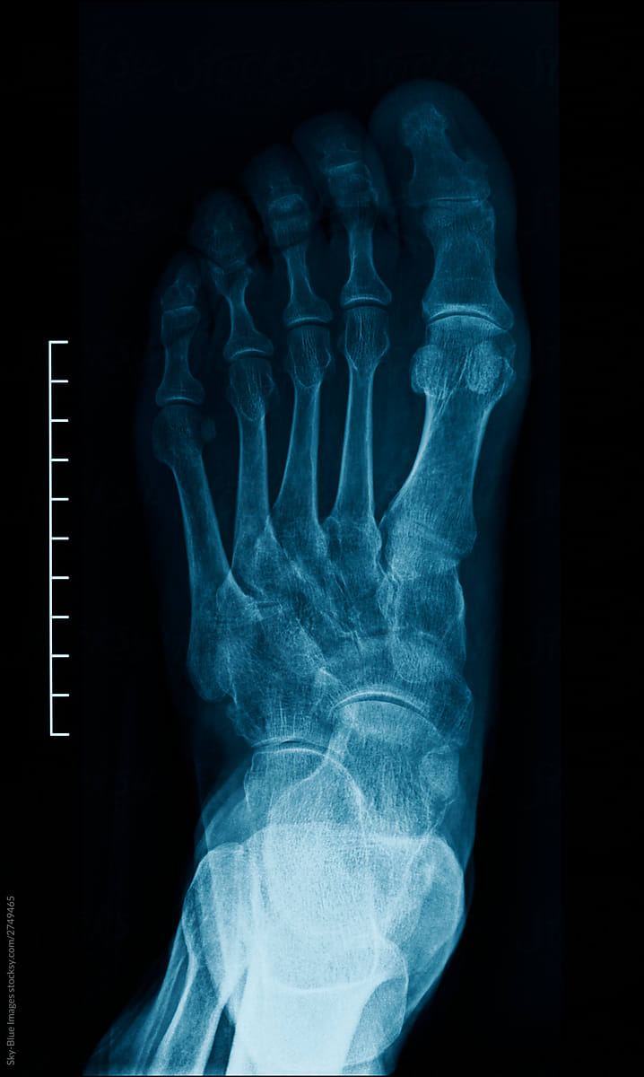 X-Ray of an human foot