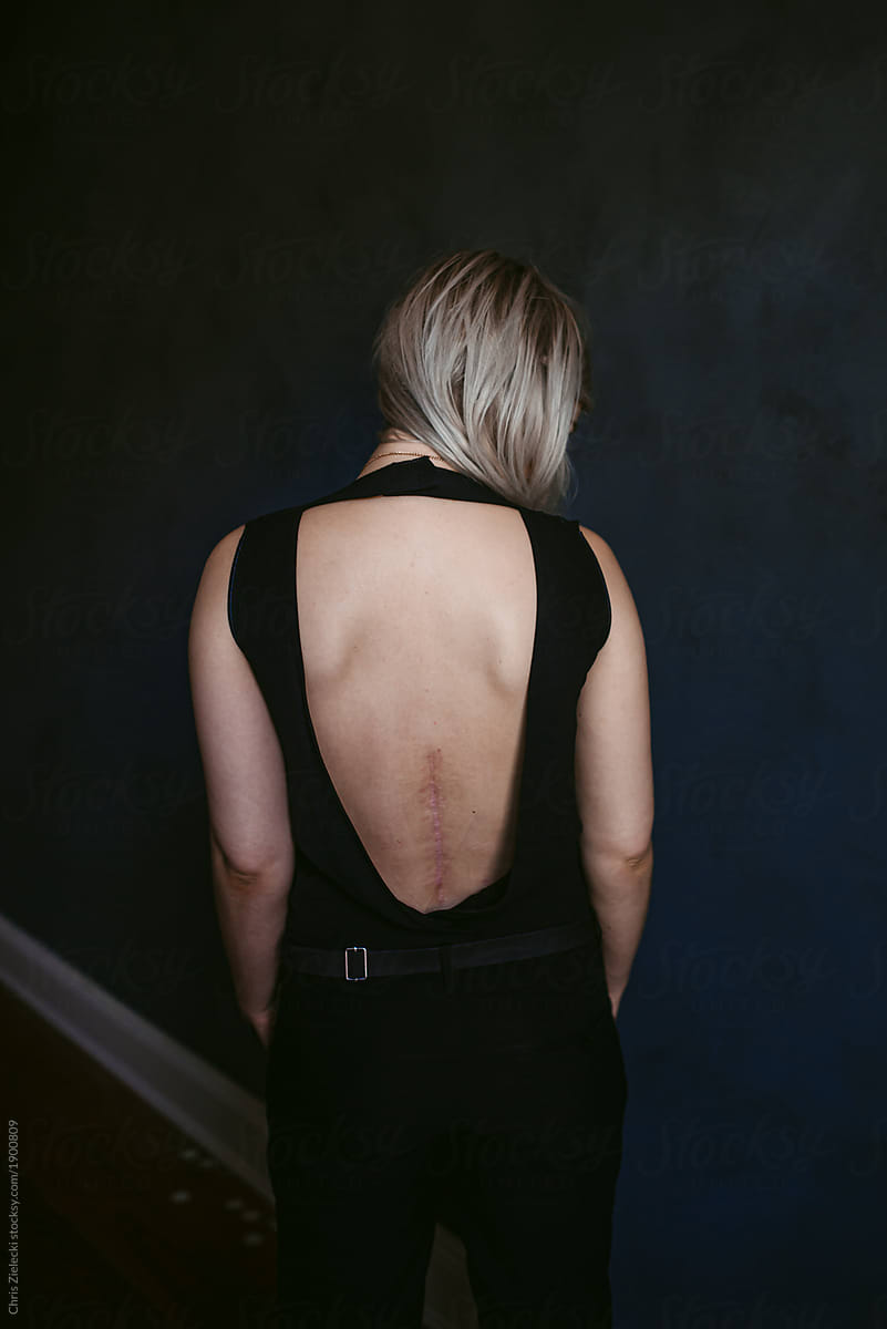 Anonymous lady in stylish gown with scar on back