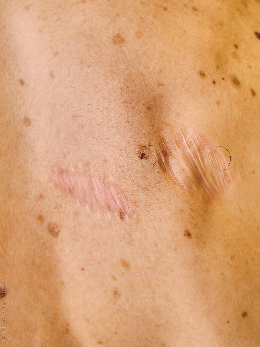 Skin Scars