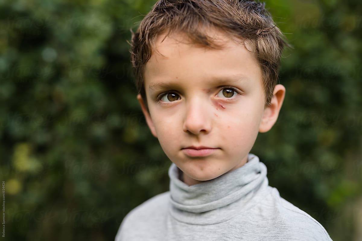 Headshot of boy with a black eye