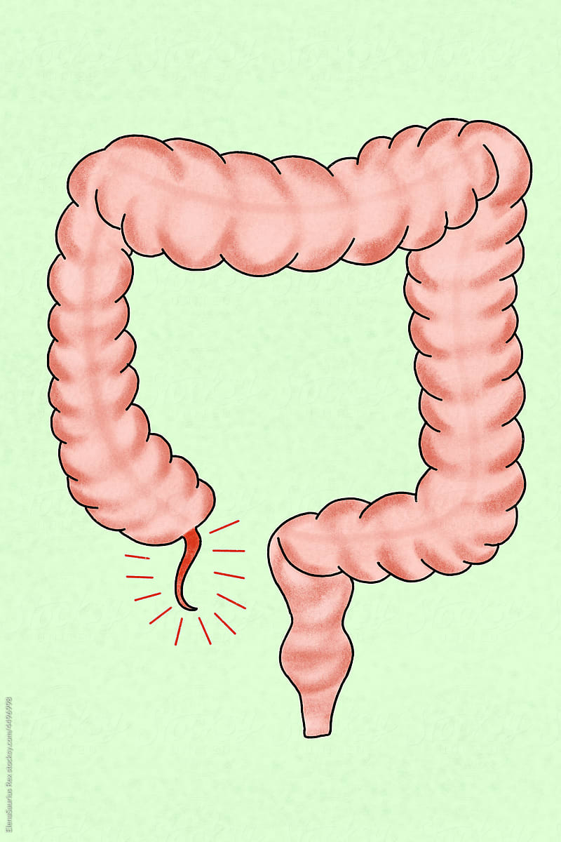 Picture of large intestine with appendicitis