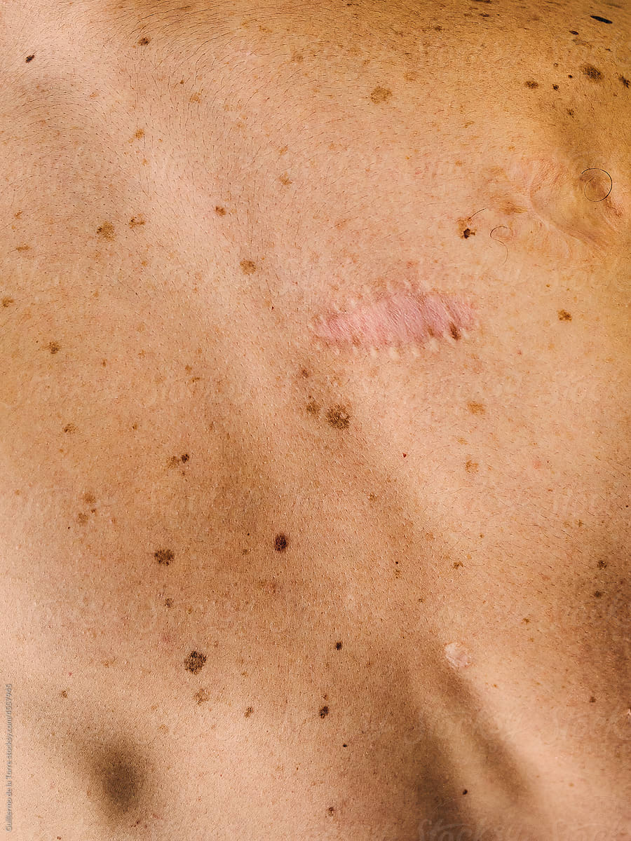 Skin Scars