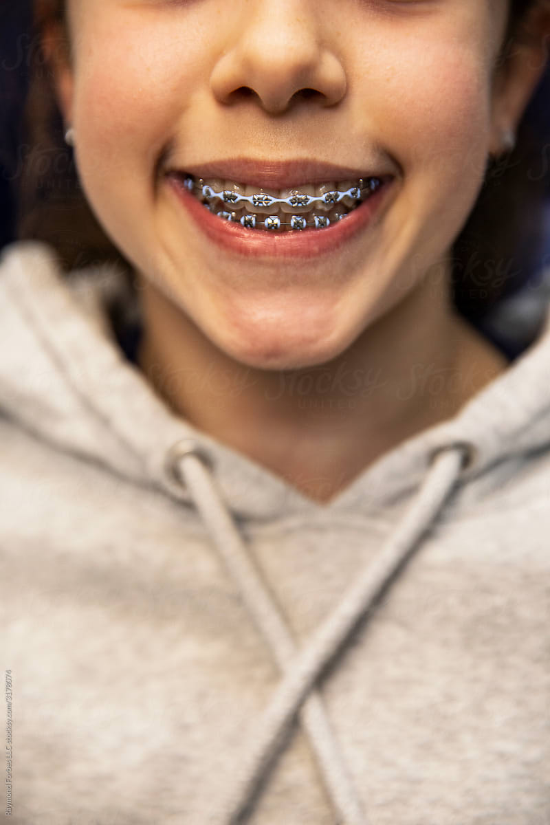 «girl Patient With Braces At Orthodontics Office Del Colaborador De