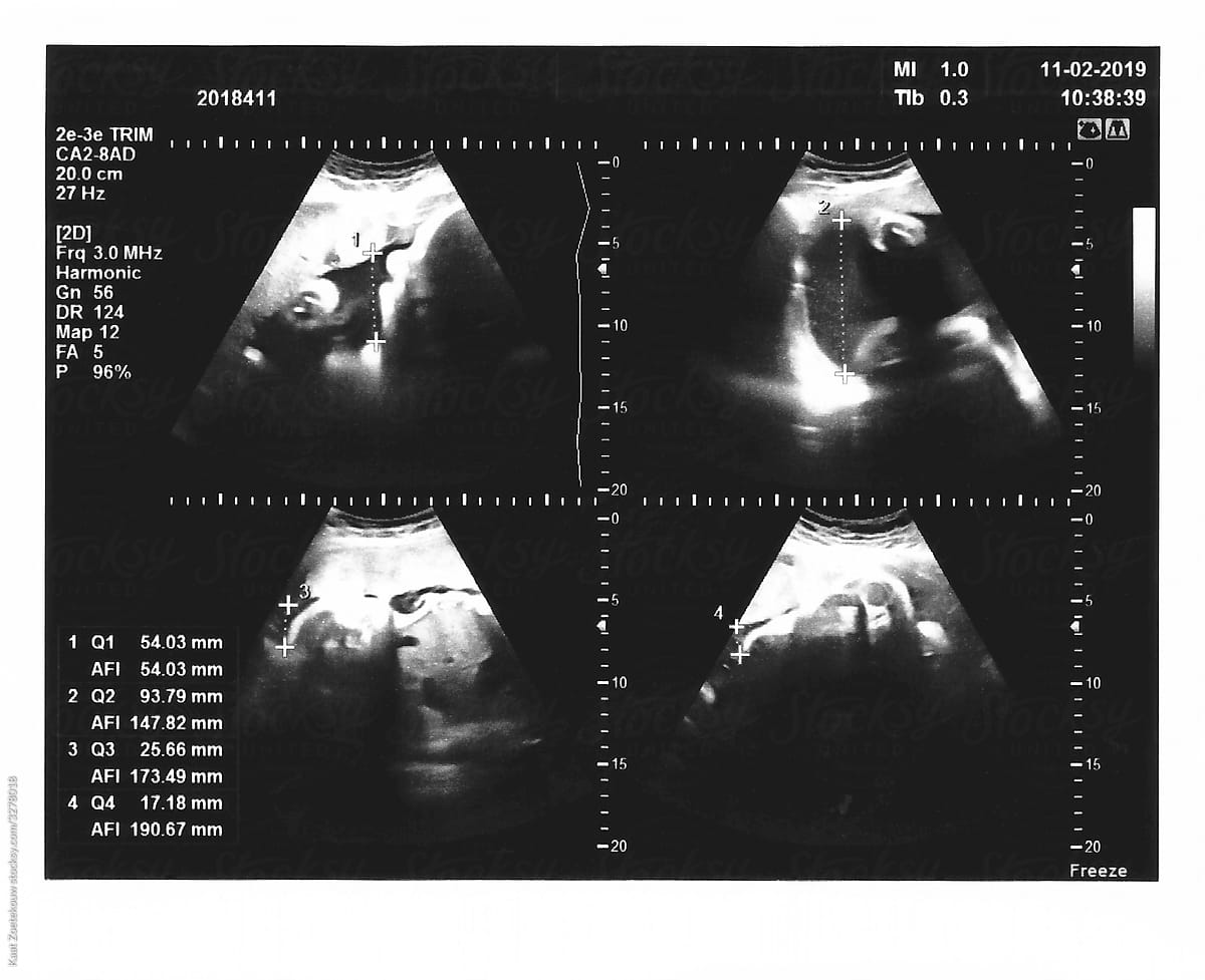 Sonogram measuring amniotic fluid