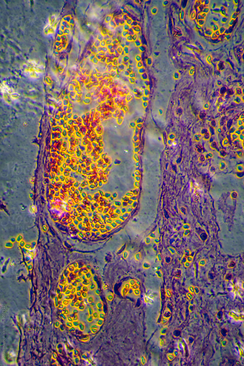 Micrograph of lobar pneumonia dissolution phase recovery stage