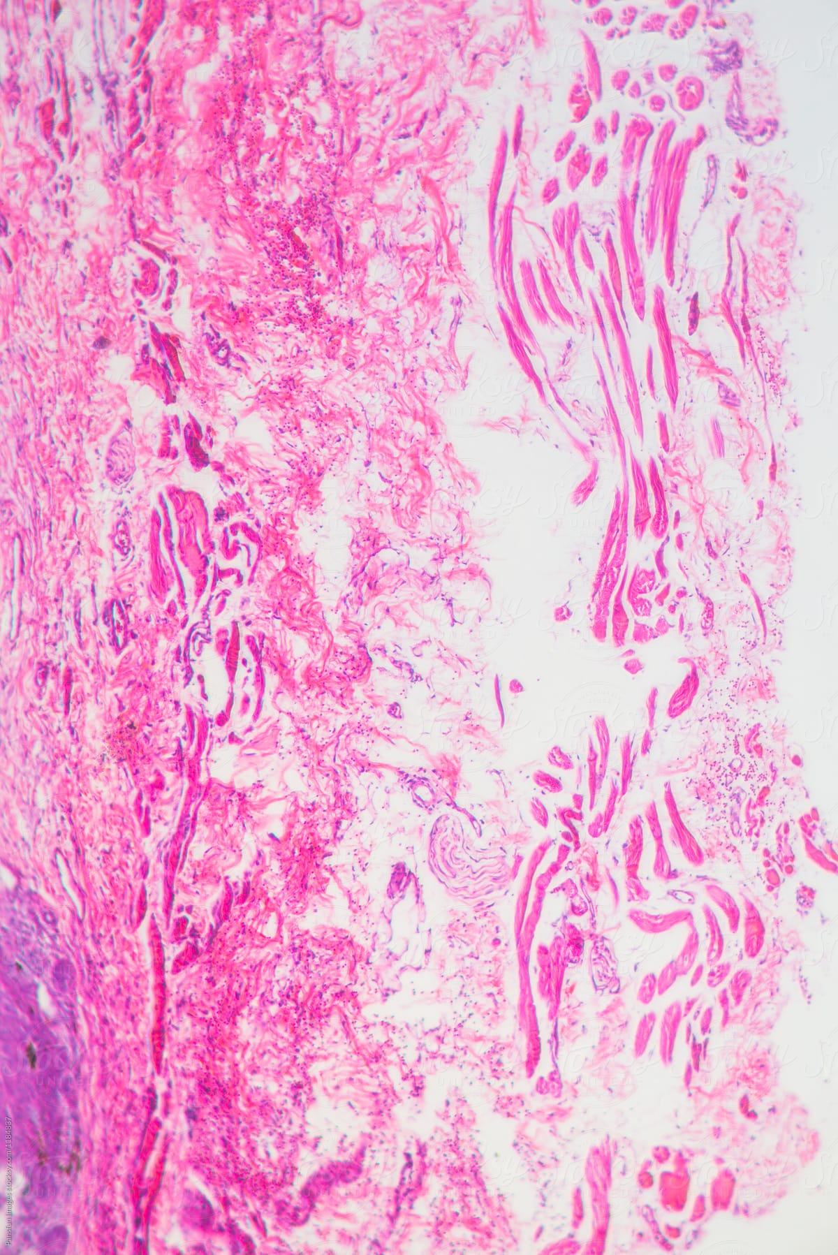 micrograph of human basal cell cancer