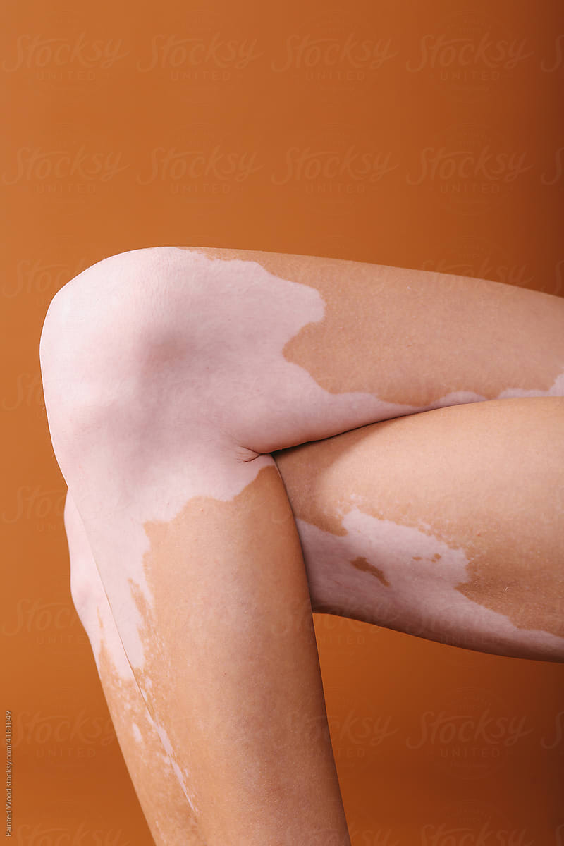 Vitiligo detail of a body