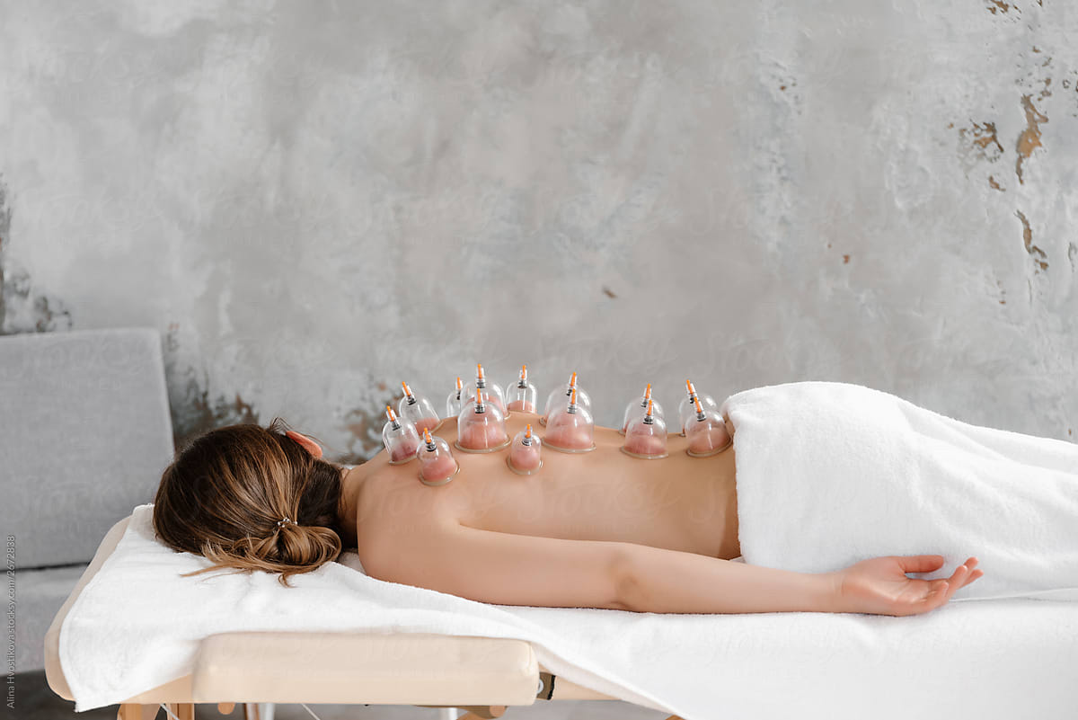 Side view of woman lying with many vacuum cups on back.