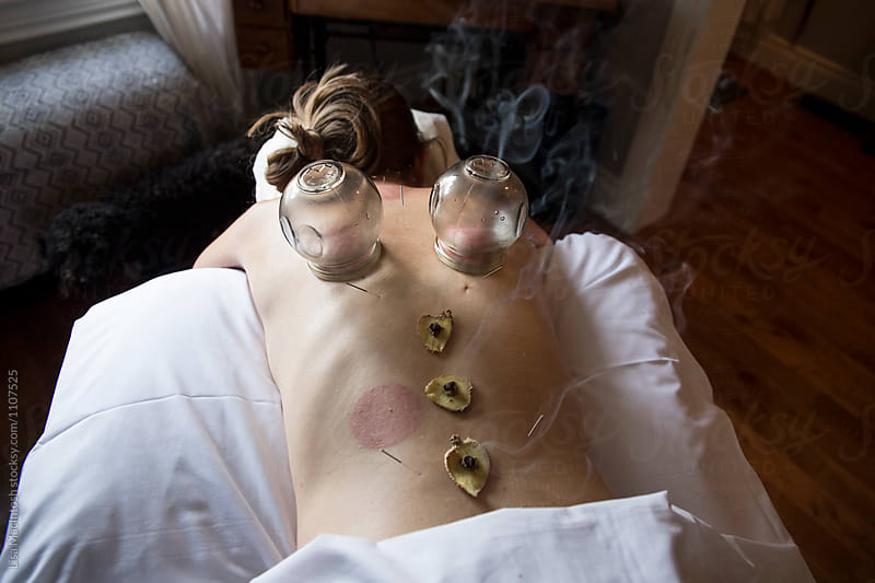 Acupuncture and glass cupping therapy on female patient