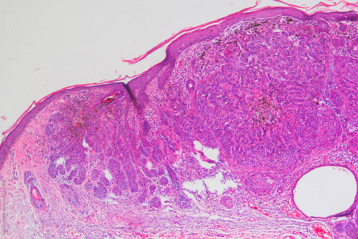 micrograph of human basal cell cancer