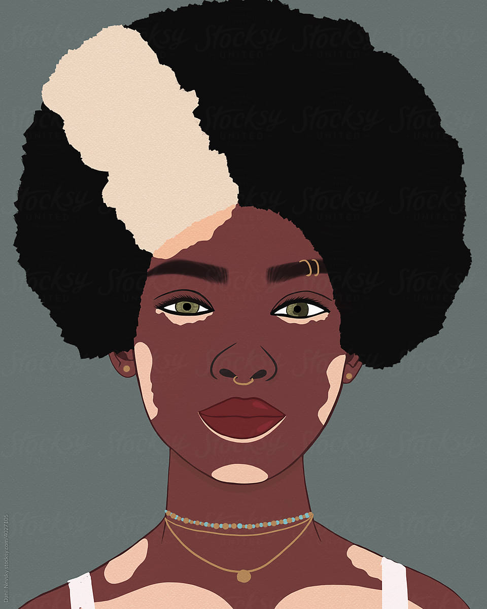 Black woman with Afro hairstyle and vitiligo