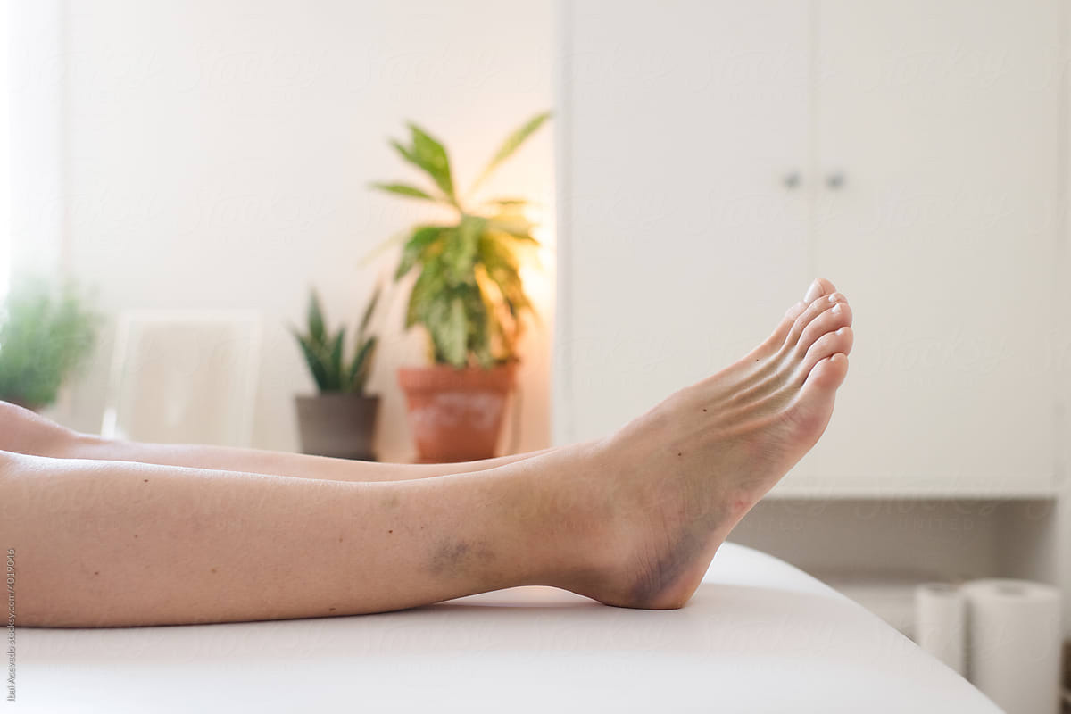 Injured female ankle on medical table