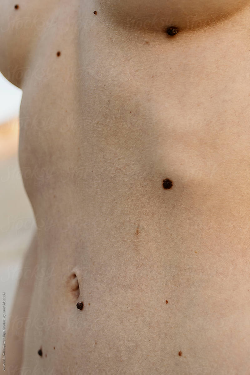 Detail-Close up photo of white skin texture with big moles on belly