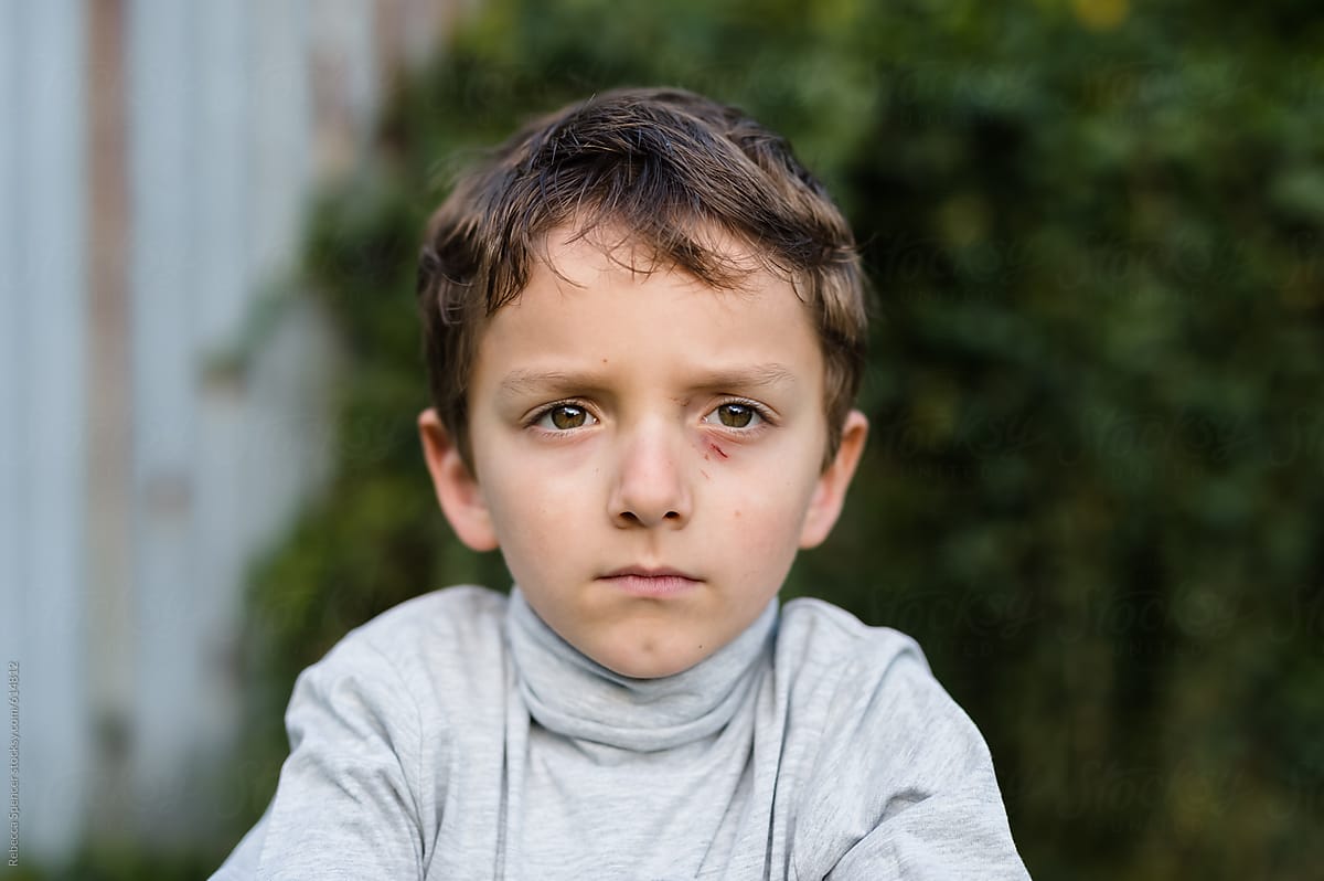 Serious child with black eye